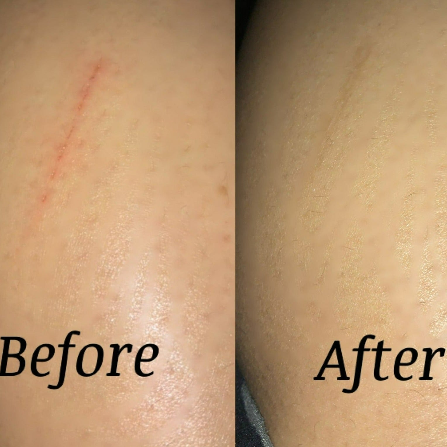 Before & After Cream On Leg